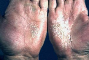 症状 手部湿疹的皮损呈亚急性或慢性湿疹表现,常发生于指背及指端掌