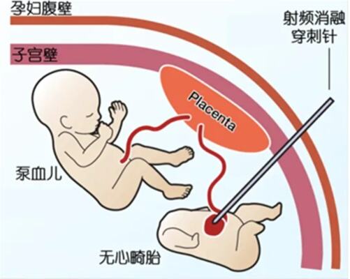 <em>双胞胎</em>一胎“无心”还在抽另一胎血,上海医护联手救治产妇和胎儿