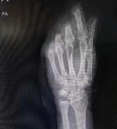 一瞬间，4根手指没了！<em>浙一专家</em>：意外来临时，千万记得这样做|浙大<em>一院</em>|手指|<em>骨科</em>|血管|断肢|肢体|健康界
