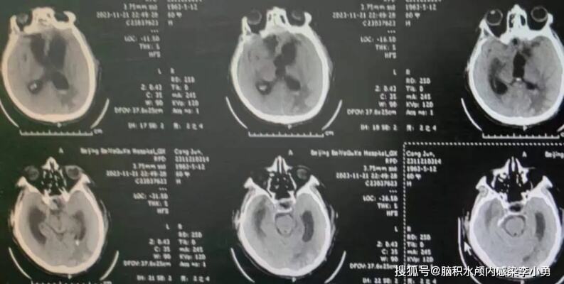 美国华盛顿大学某著名<em>医院</em>神经外科，昨晚也享用了李小勇脑脊液科的保驾护航