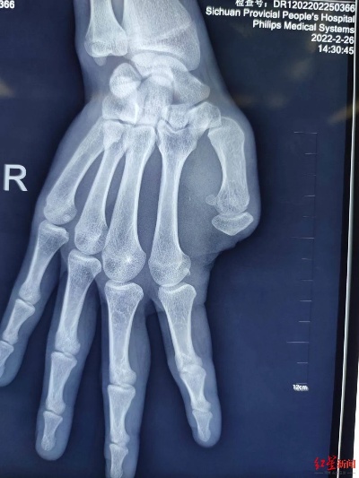 “移花接木”22岁小伙大拇指因意外缺失，<em>骨科医生</em>用脚趾头为他成功再造_肖成伟_手术_功能