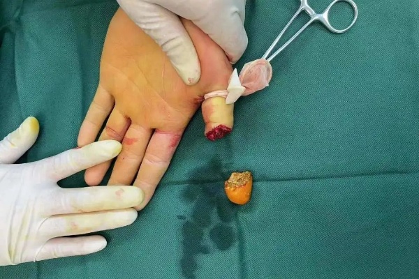 惊险！22岁小伙拇指指尖断离，同合<em>骨科医生</em>妙手再植_手指_伤口_<em>手术</em>