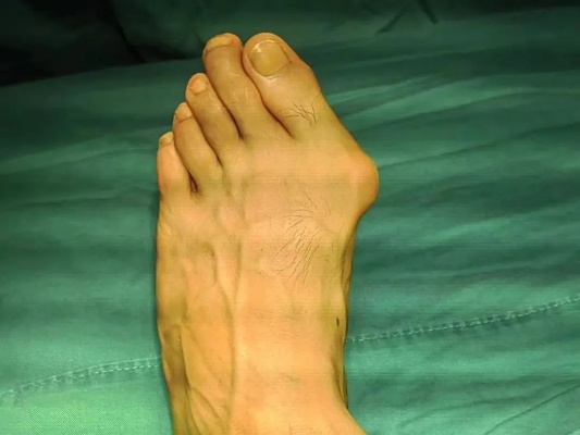 两江二院（中医院）成功完成双足拇<em>外翻</em>矫形术，解患者多年之痛|矫形术|<em>骨伤科</em>|脚趾|矫形|足部|健康界