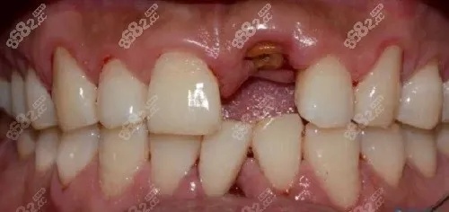 记录我9院种植牙全过程：赖红昌种牙<em>挂号</em>难但技术没得挑