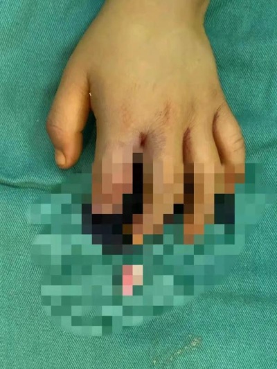 3岁男孩手指被切断5小时，<em>贵阳医生</em>手术“接活”