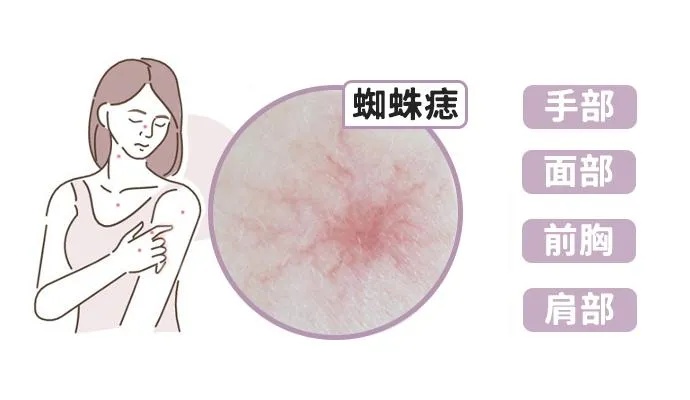 34岁男子被确诊！<em>宁波</em>人注意：身上出现这种“红疹”可能是肝癌！