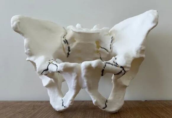 新技术|3D打印助哈医大一院群力<em>骨科</em>找出复杂骨盆骨折微创手术最佳方案|