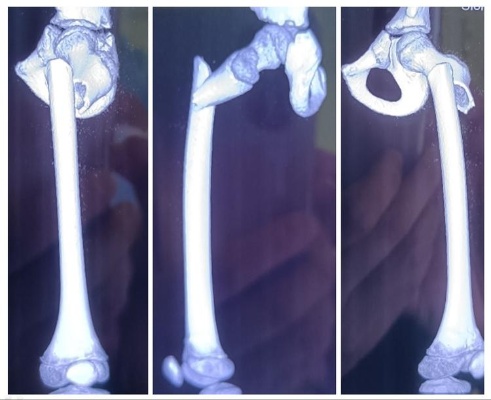 <em>广西</em>首例 <em>南溪山医院</em>运用3D打印钢板治疗小儿股骨转子下骨折|手术|3d打印|<em>骨科</em>_网易订阅