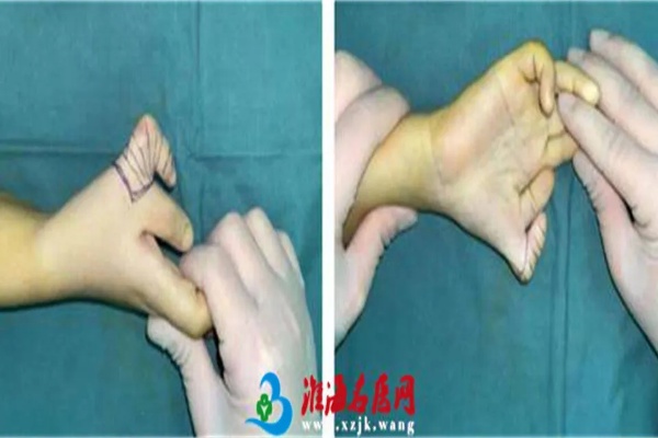 <em>徐州</em>仁慈医院<em>小儿骨科</em>：拇指多指畸形中最不常见的VII型，如何治疗？