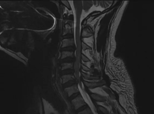 脊柱外科再战高难度—前路颈椎手术解决多节段脊髓型颈椎病_治疗_胡大爷_<em>李亮</em>