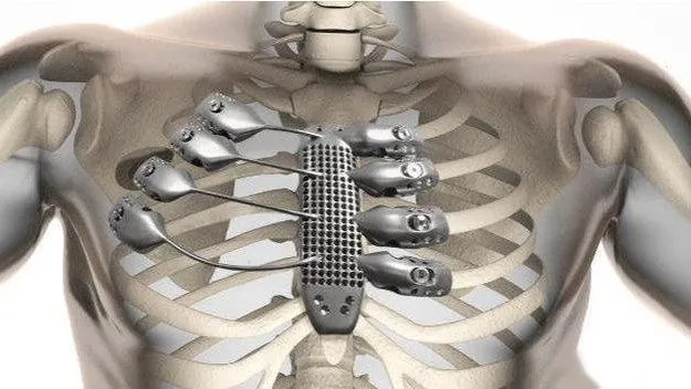 心胸外科/<em>骨科肌肉</em>骨骼手术耗材-肋骨骨折外固定材料及产品特点-<em>知乎</em>