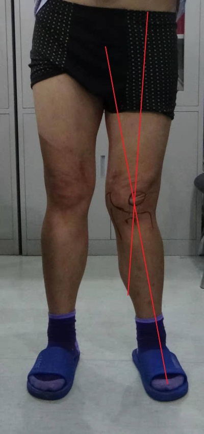 O型<em>腿</em>和<em>X型腿</em>需要<em>矫正</em>！<em>医生</em>：这是膝关节畸形，影响美观和健康|矫形|畸形|膝关节_新浪新闻