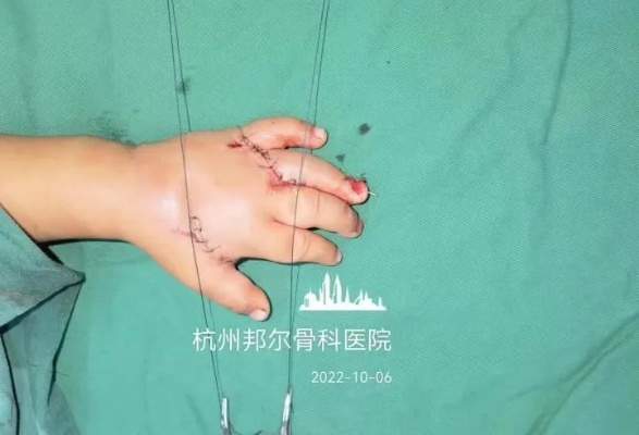 指尖血管细如发丝，<em>杭州</em>一<em>骨科医院</em>接上了1岁宝宝的断指|<em>骨科</em>|手术|断指_新浪新闻