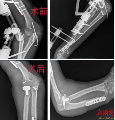 <em>永州</em>市中医医院成功开展上肢多发骨折术后翻修手术