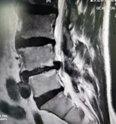 重医三院·医疗动态丨<em>脊柱外科</em>运用微创MIS-TLIF技术解除七旬老年患者腰椎疼痛