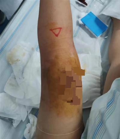 6岁女孩遭遇车祸腿上被“咬开”拳头大血洞,医生精细操作缝合6根<em>肌腱</em>,成功保住孩子左腿
