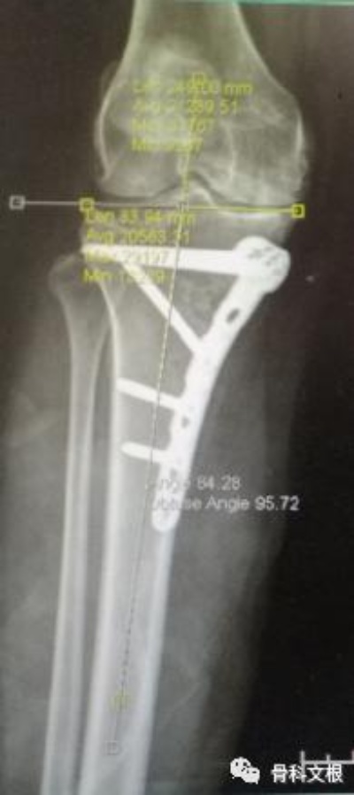 关节炎“保膝”新选择—HTO术 <em>上海六院骨科</em>文根|骨关节炎|关节炎|膝关节|健康界