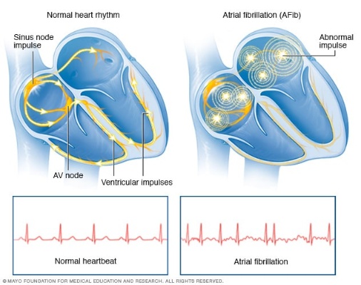 心脏<em>消融术</em>的原理及发展趋势|<em>消融</em>|脉冲|<em>射频</em>|生理|技术|健康界
