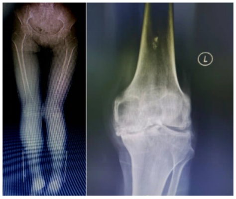 <em>哈医大一院</em>群力<em>骨科</em>应用新技术实现我省首例不开髓全膝关节置换|膝关节|精准|教授|患者|定位|健康界
