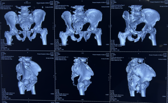 新技术|3D打印助<em>哈医大一院</em>群力<em>骨科</em>找出复杂骨盆骨折微创手术最佳方案！<em>骨科</em>|骨折|骨盆|打印|治疗|健康界
