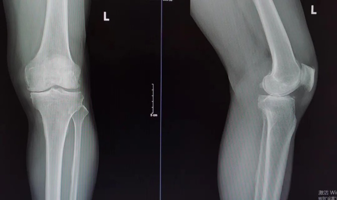 力达康XU固定平台单髁临床应用—<em>济南</em>南郊<em>医院</em>|单髁置换术|膝关节|XU|单髁|双膝|<em>骨科</em>|健康界