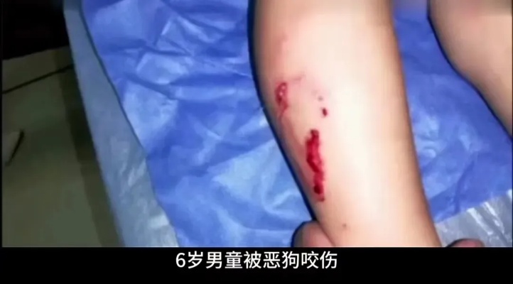 安徽芜湖，6岁男童被恶狗咬伤，眼部脖子到处是伤，明明已经注射3针<em>狂犬疫苗</em>，仍在1