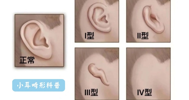 <em>同济</em>刘嘉锋|宝宝先天性小耳畸形,一定要做全耳再造吗?