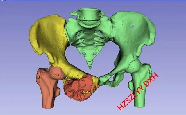 AI+医疗|图像融合建模和3D打印技术,助力精准切除<em>骨</em>肿瘤