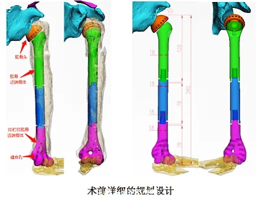 <em>贵州</em>首例！贵医附院成功开展3D打印仿生型全肱骨置换手术