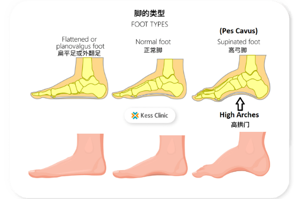 <em>骨科专家</em>：<em>惠州</em>妈妈请注意，小孩喜欢踮着脚走路，很有可能是扁平足！
