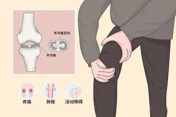 <em>广州</em>和平<em>骨科医院</em>康复医学科」半月板损伤患者的处理方法_活动_训练_膝关节