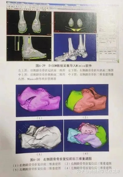 数字化足踝手术—<em>骨科</em>3D打印技术在跟骨<em>骨折</em>的应用_关节_下关_模型
