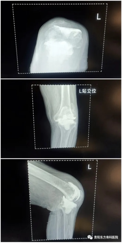 重塑新“膝”望|CCK膝关节假体翻修术后患者行走功能得到明显改善_<em>骨科医院</em>_东方_左膝