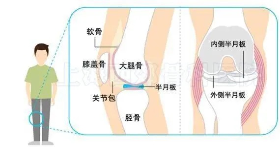 <em>郴州骨科医院</em>提醒：膝盖卡卡肿痛，是半月板在抗议！