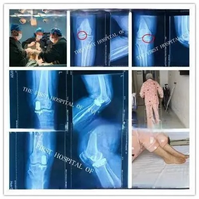 榆林一院绥德院区<em>骨科</em>一病区成功完成一例双膝骨关节炎双侧同期单髁表面成形术