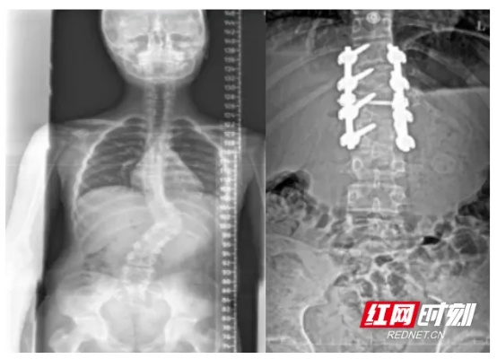 脊柱“皇冠手术”助12岁脊柱侧弯少年重获新生_长沙市第<em>一医院</em>_健康频道