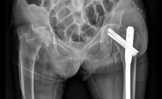 哈市<em>二院骨</em>外一科成功为93岁老人完成股骨粗隆间微创闭合复位固定术