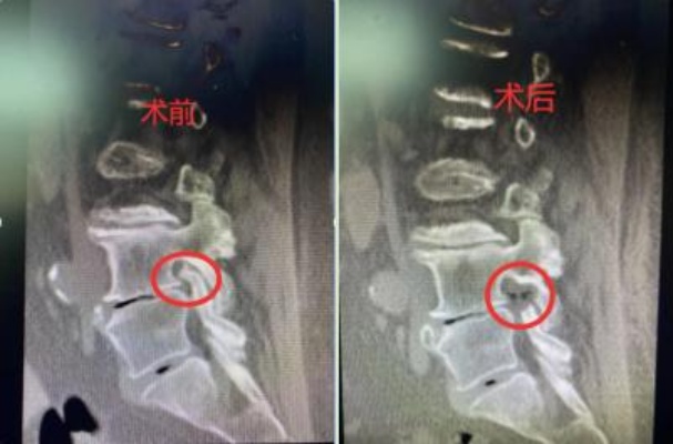 <em>北亚</em>中医<em>骨伤科</em>全可视化脊柱内镜技术让八旬老人不再腿疼！<em>骨伤科</em>|神经根|椎间孔|内镜|脊柱|健康界