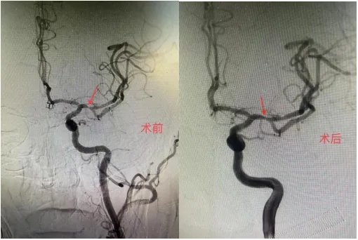 北京<em>北亚骨科医院</em>神经外科|2例男性高龄脑血管支架植入术病历|神经外科|脑血管|植入术|病历|健康界