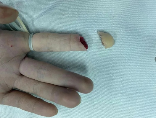 手指离断伤接二连三，发生意外正确处理或可挽回|断伤|手指|意外|<em>骨科</em>|健康界