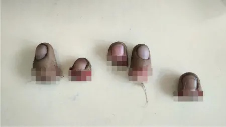 越南籍男子5根手指在<em>上海</em>天佑<em>医院</em>成功再植“复活”手指|血管|断指|<em>骨科</em>|健康界