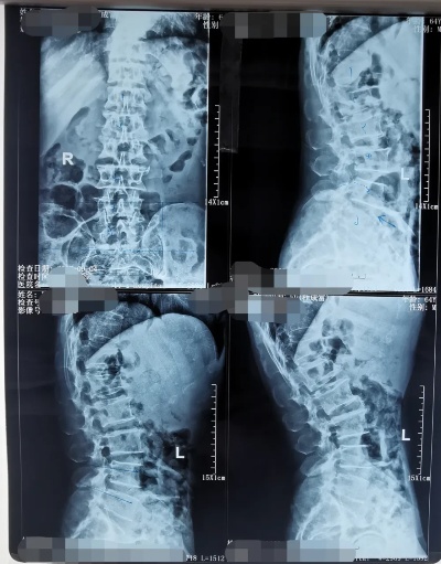 院内首例∣<em>延安市人民医院骨科</em>一病区巧用3D打印多孔型钛合金椎间融合器妙解腰椎之痛