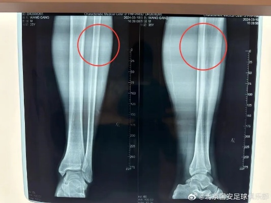 国安官方：王刚左小腿中上段<em>腓骨</em>裂纹<em>骨折</em>，据悉将伤缺三个月