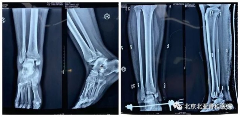 <em>北亚中医</em>骨伤<em>科</em>技术创新运用有限切开单切口三入路技术治疗一例复杂三踝骨折患者！