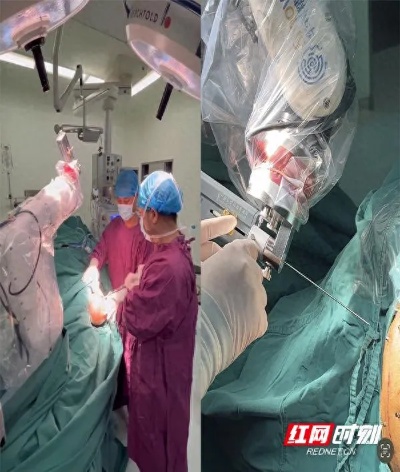 <em>湘雅三医院</em>完成全国首例国产新型双靶点STN+8触点脑起搏器植入术
