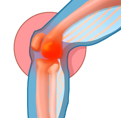 女性的膝<em>关节</em>更易损伤？和这些因素“膝膝”相关！