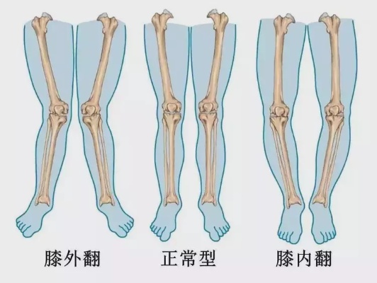 “O”<em>型腿</em>、“X”<em>型腿</em>详解及<em>矫正</em>方案|<em>o型腿</em>|关节|肌肉|胫骨|髌骨_手机网易网