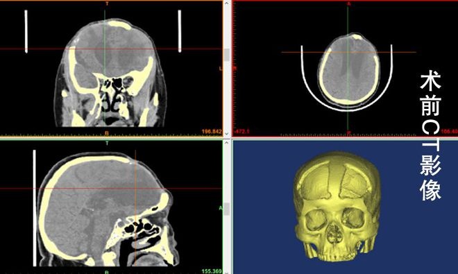 <em>泰安市中心医院</em>神经<em>外科</em>应用3D颅骨打印技术完美修复颅骨缺损|
