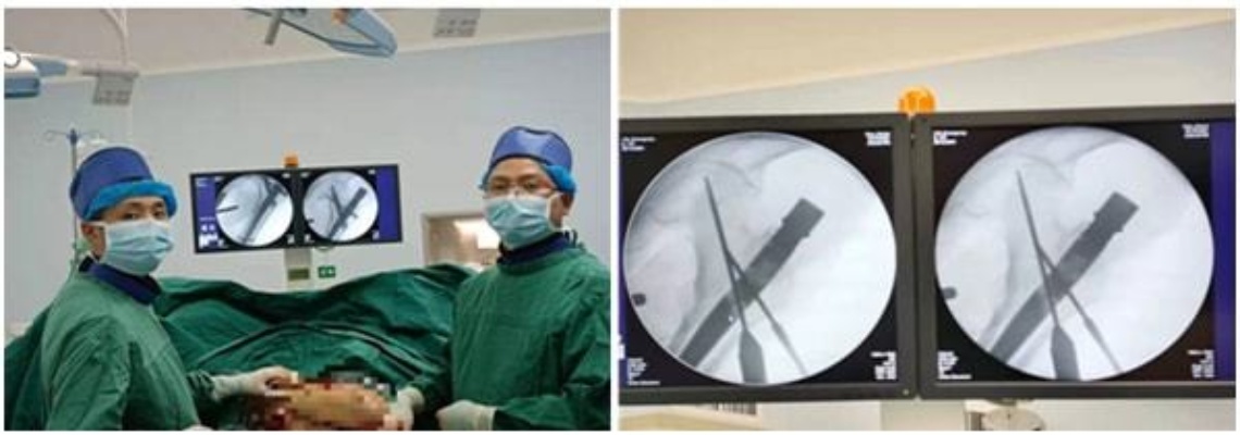 【医疗技术】<em>重庆渝东医院</em>率先在本地区开展首例PFBN股骨近端仿生髓内钉技术|骨折|手术_网易订阅