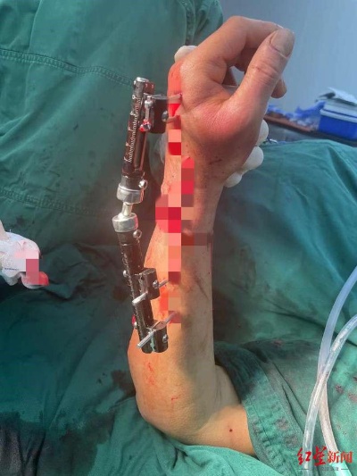 57岁洗衣工手腕被铰断，<em>骨科</em>医生9小时手术再植，一半多时间在显微镜下接血管|离断|断肢_网易订阅
